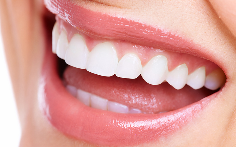 歯の黄ばみは「ホワイトニング」で削らずに白く